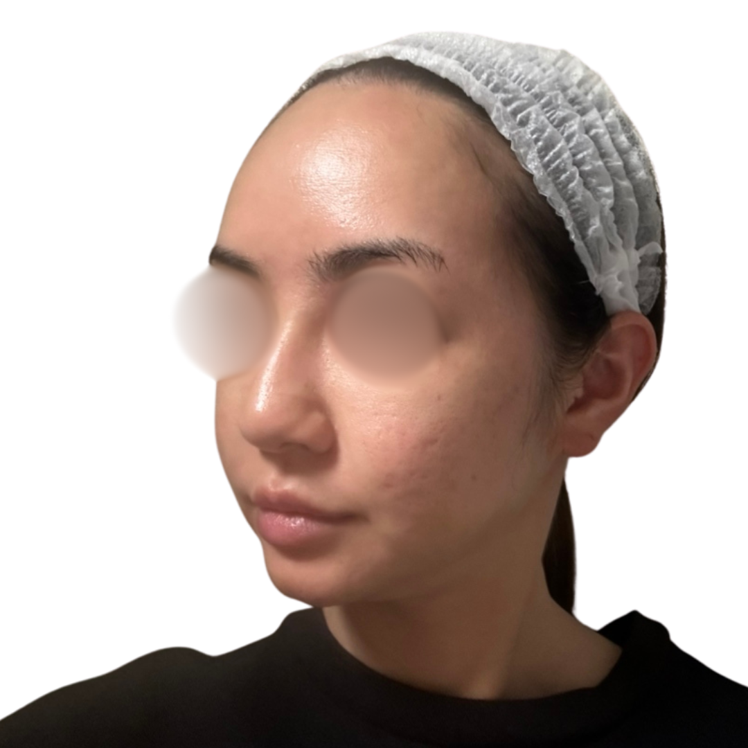 サブシジョン（クレーター治療）